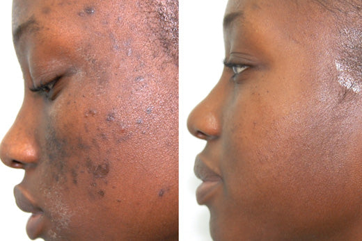 What Are Dark Spots And How to Get Rid of Them?