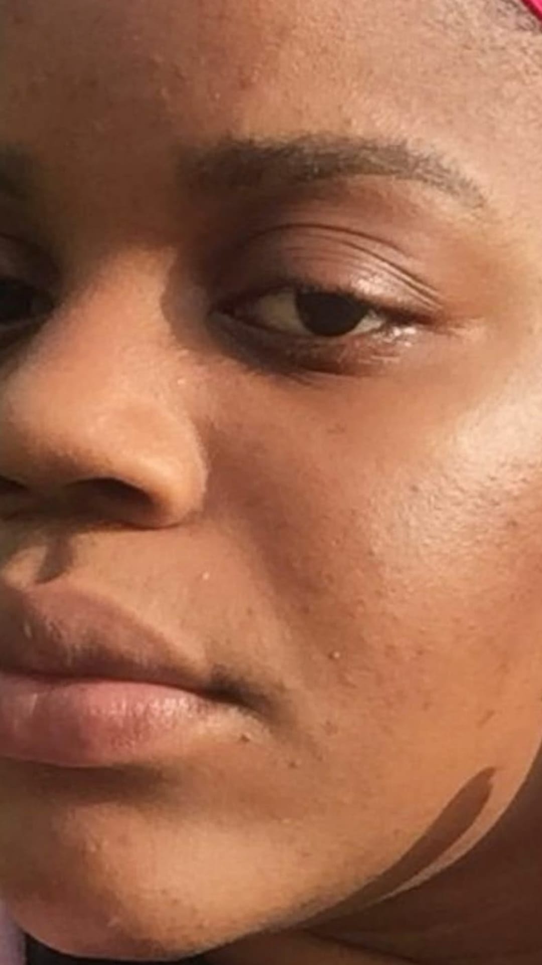 Acne Spot Treatment: What to Use, and When
