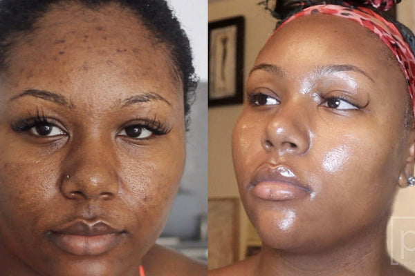 Perfec-Tone before and after, real client results on dark spots and uneven tone