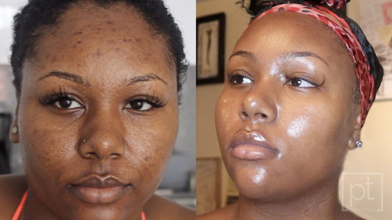 Perfec-Tone before and after, real client results on dark spots and uneven tone