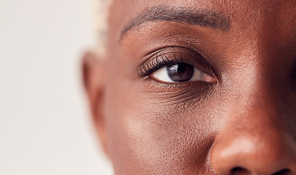How to Get Rid of Dark Circles