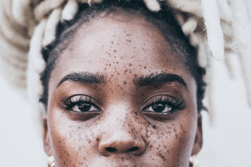 How to Treat Hyperpigmentation