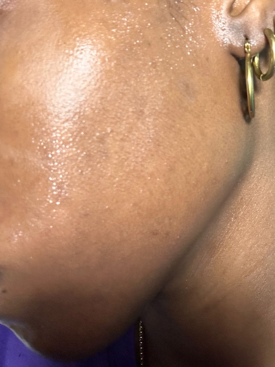 Davinia Capron after 30 days using Spot Eraser