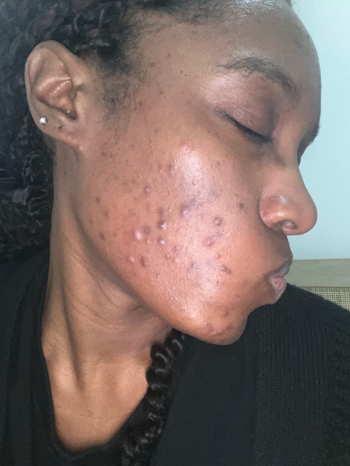 Eryqa’s right-side profile with visible breakouts and dark marks, in a customer-provided photo.