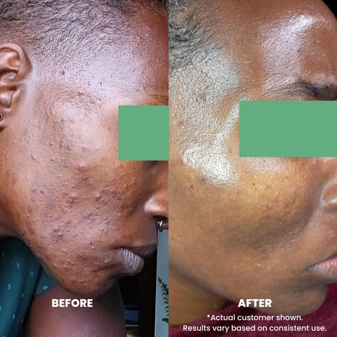 Perfec-Tone Clinical Strength Resurfacing Crème 30ml and 50ml