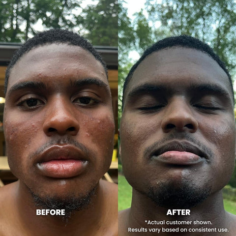 Perfec-Tone Exfoliating Cleanser - Salicylic Acid Face Wash 2oz and 4oz