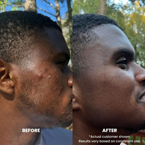 Perfec-Tone Exfoliating Cleanser - Salicylic Acid Face Wash 2oz and 4oz