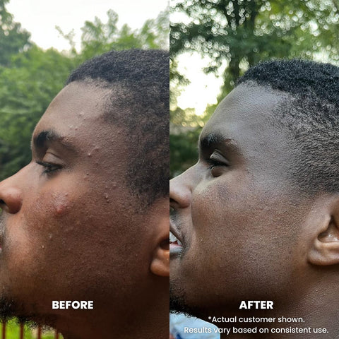 Perfec-Tone Exfoliating Cleanser - Salicylic Acid Face Wash 2oz and 4oz