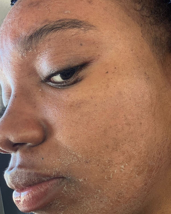 Olive on day 12, marks a shade darker while the Resurfacing Crème works
